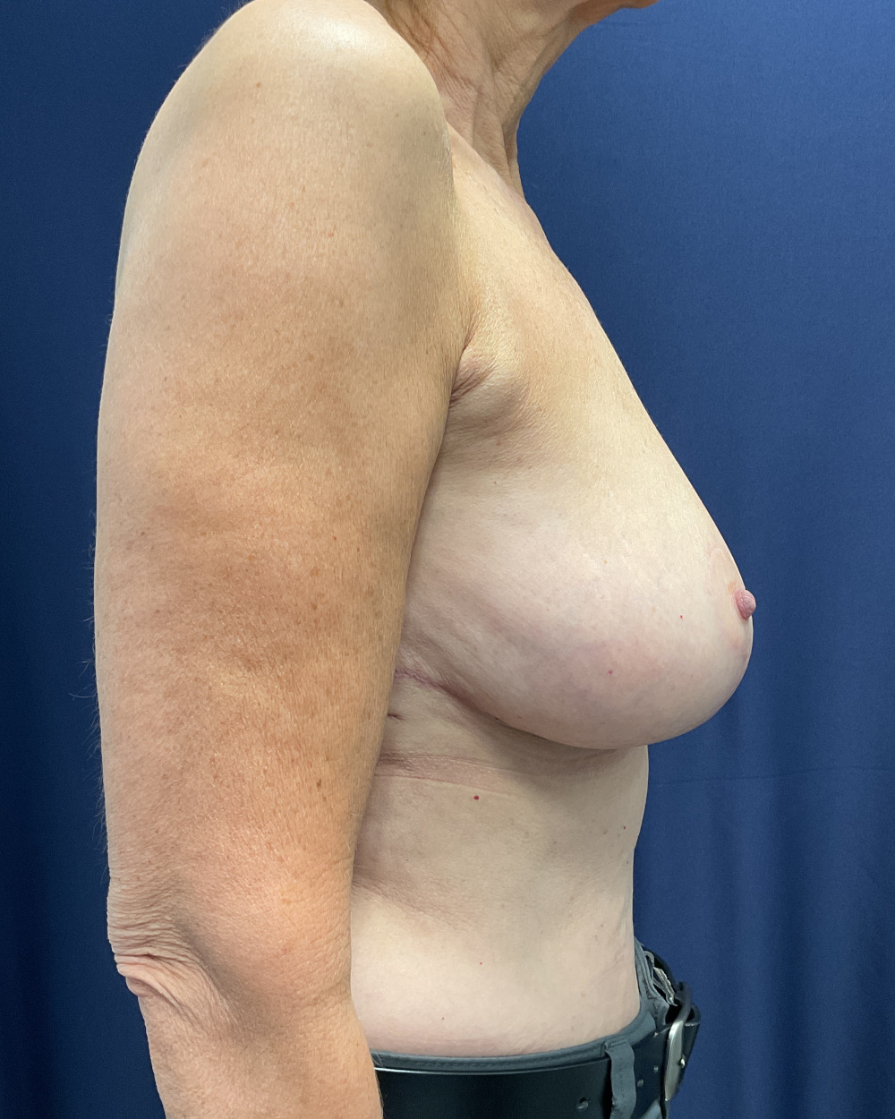 Breast Lift Patient Photo - Case 4288 - after view-3