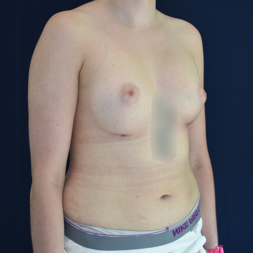 Breast Augmentation Patient Photo - Case 4316 - after view-1