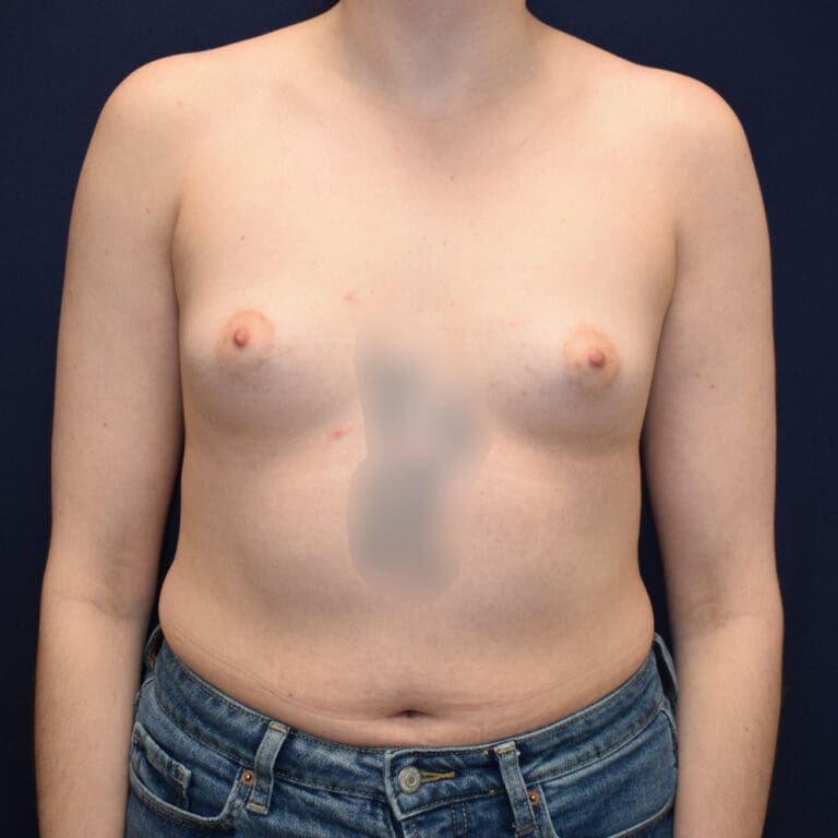 Breast Augmentation - Case 4316 - Before
