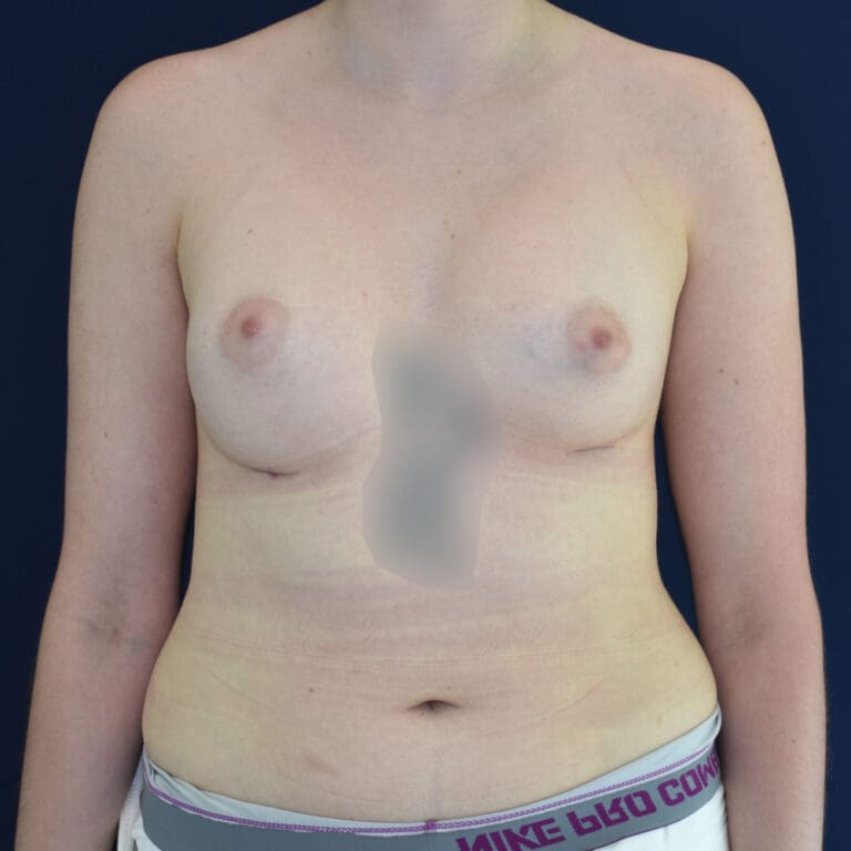 Breast Augmentation - Case 4316 - After