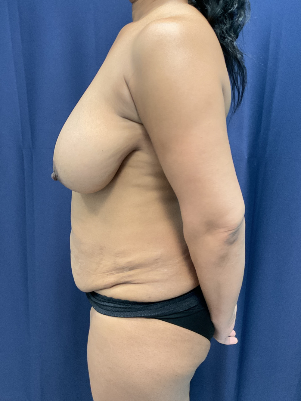 Abdominoplasty Patient Photo - Case 4431 - before view-2