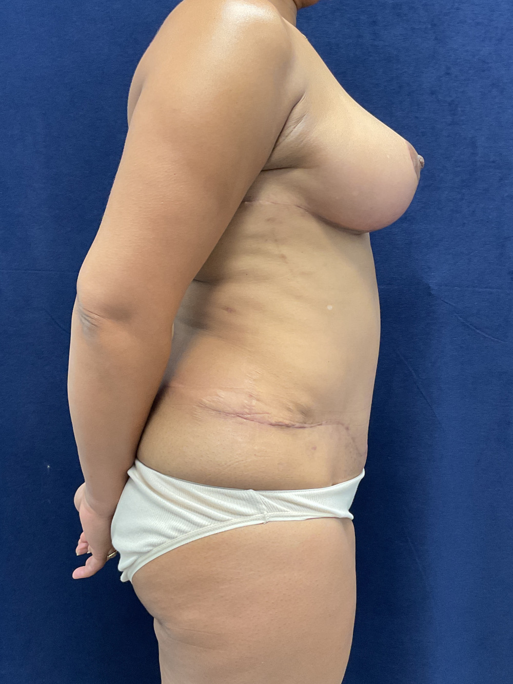 Abdominoplasty Patient Photo - Case 4431 - after view-4