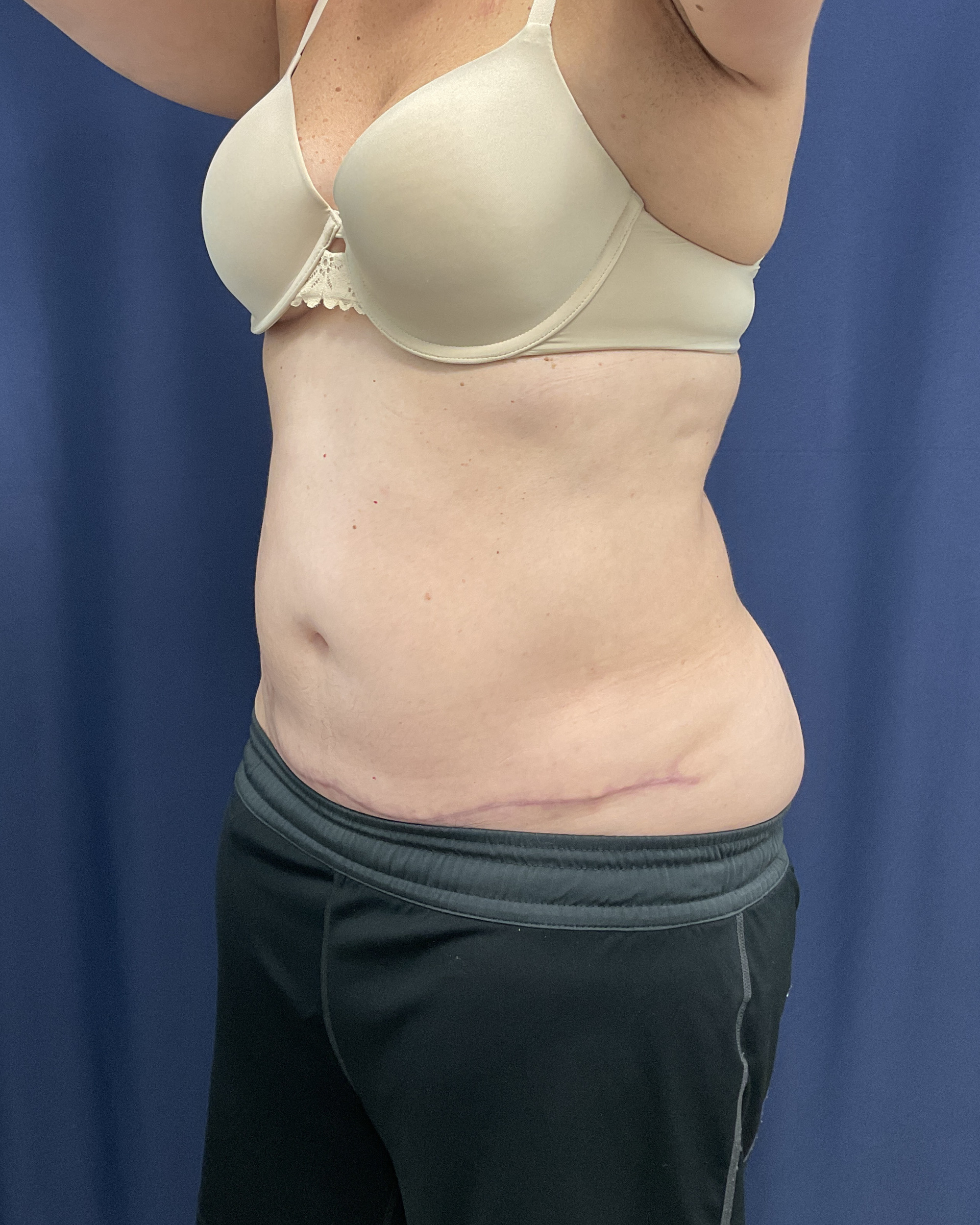 Abdominoplasty Patient Photo - Case 4467 - after view-1