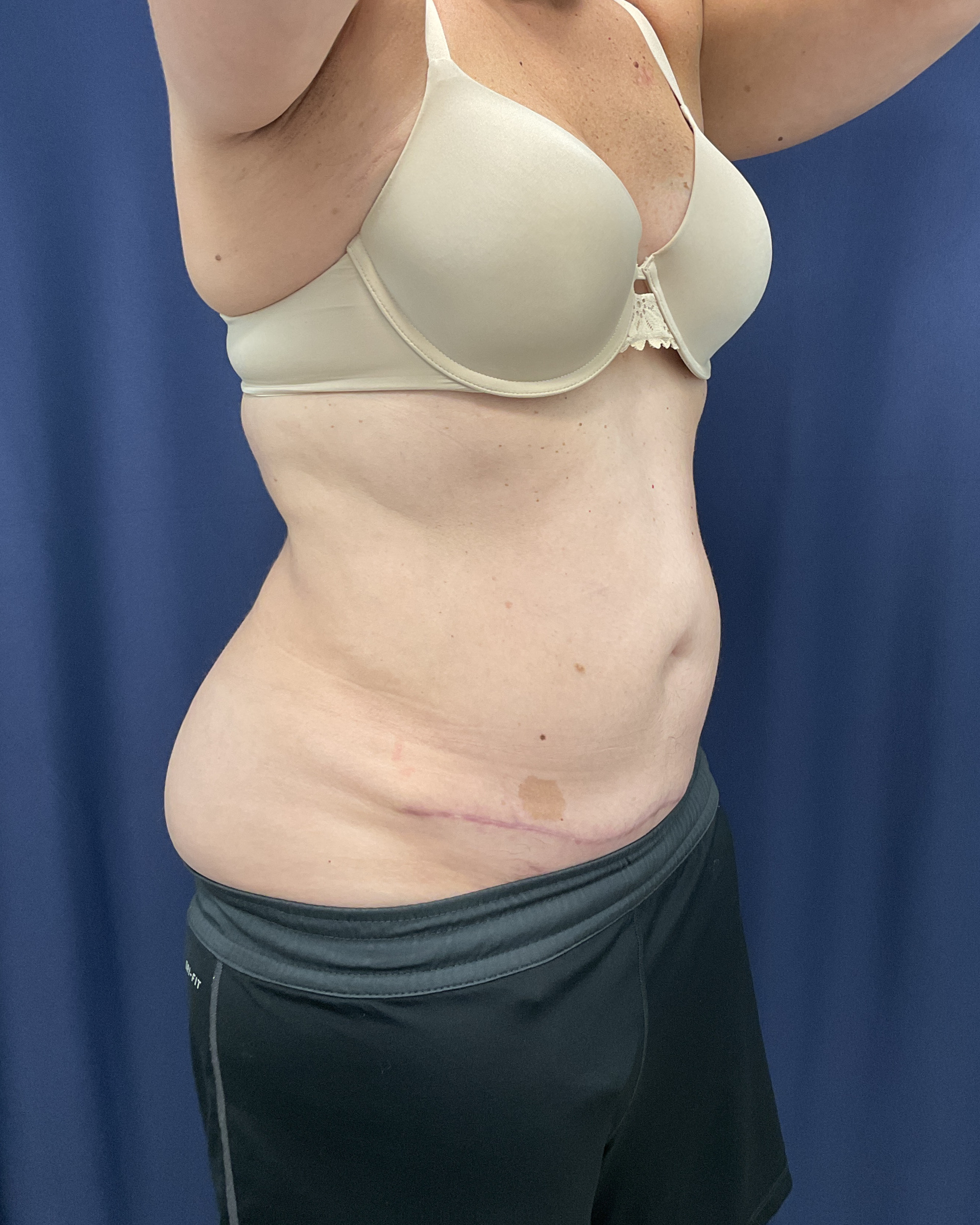 Abdominoplasty Patient Photo - Case 4467 - after view-2