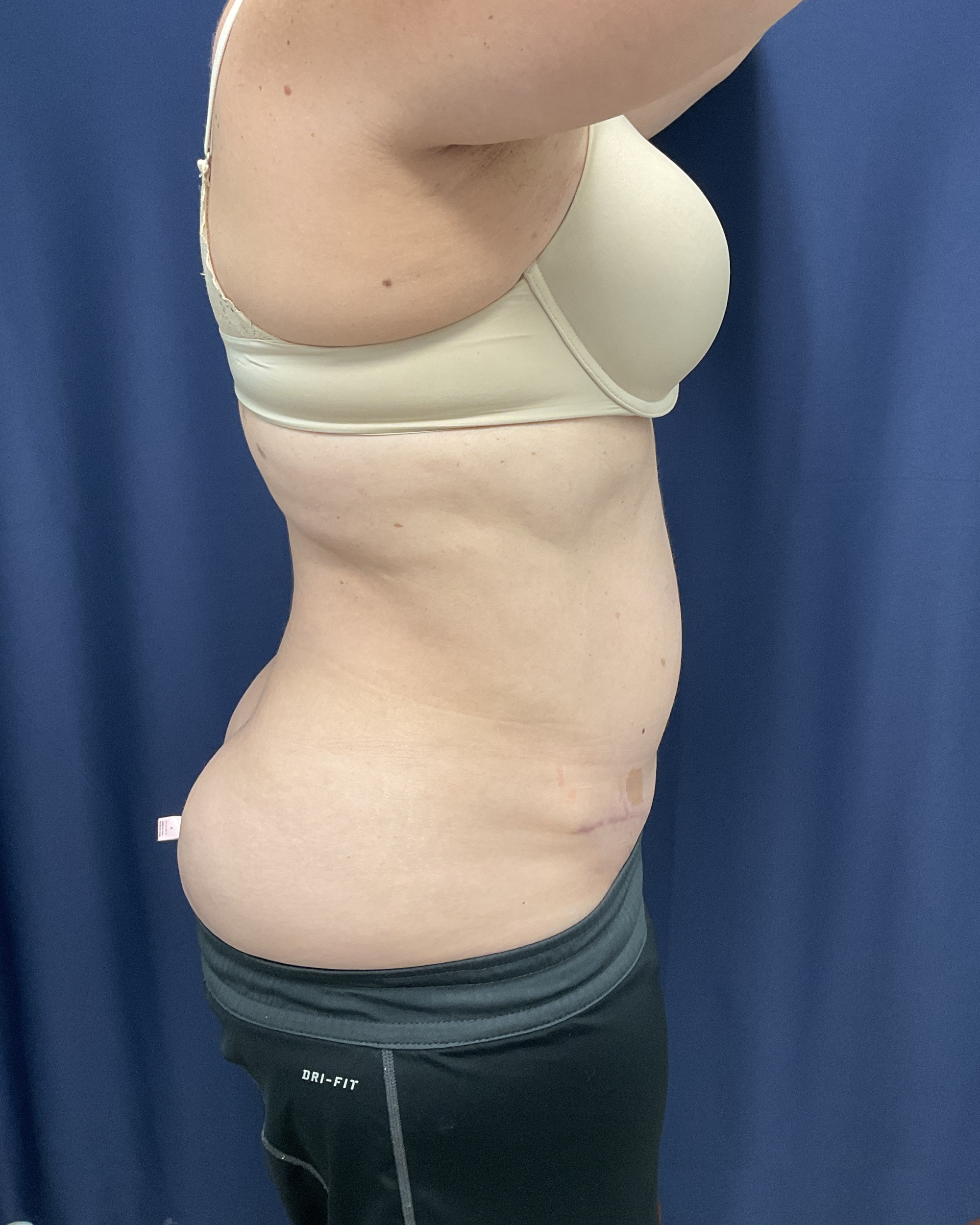 Abdominoplasty Patient Photo - Case 4467 - after view-3