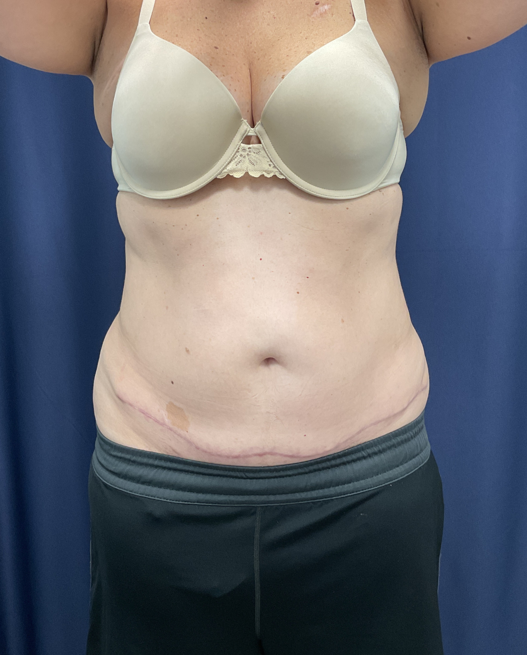 Abdominoplasty Patient Photo - Case 4467 - after view