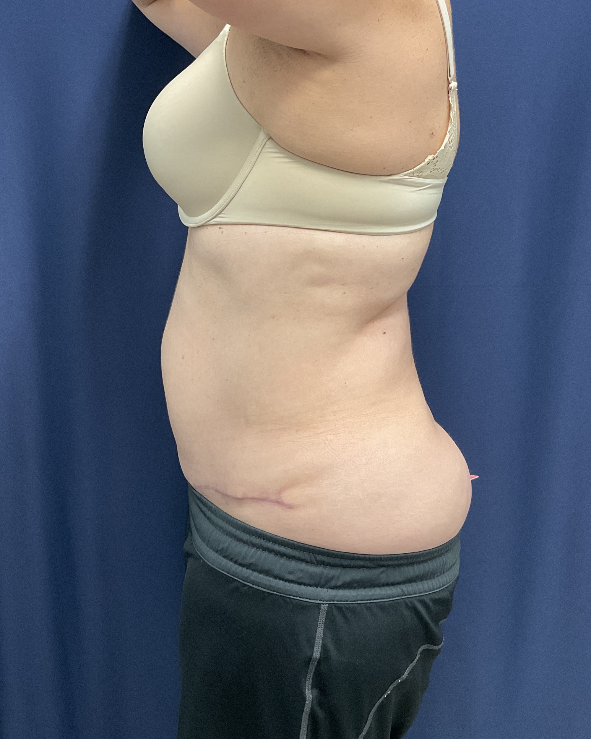 Abdominoplasty Patient Photo - Case 4467 - after view-4