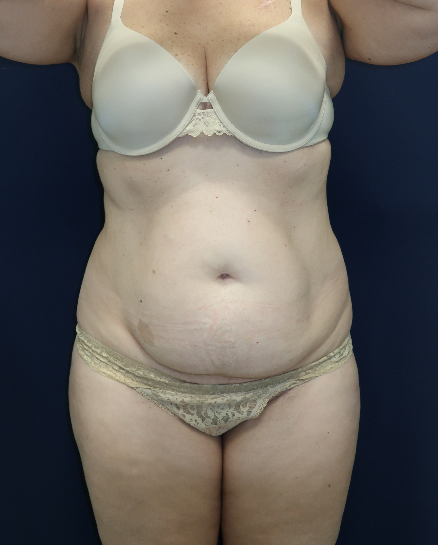 Abdominoplasty Patient Photo - Case 4467 - before view-