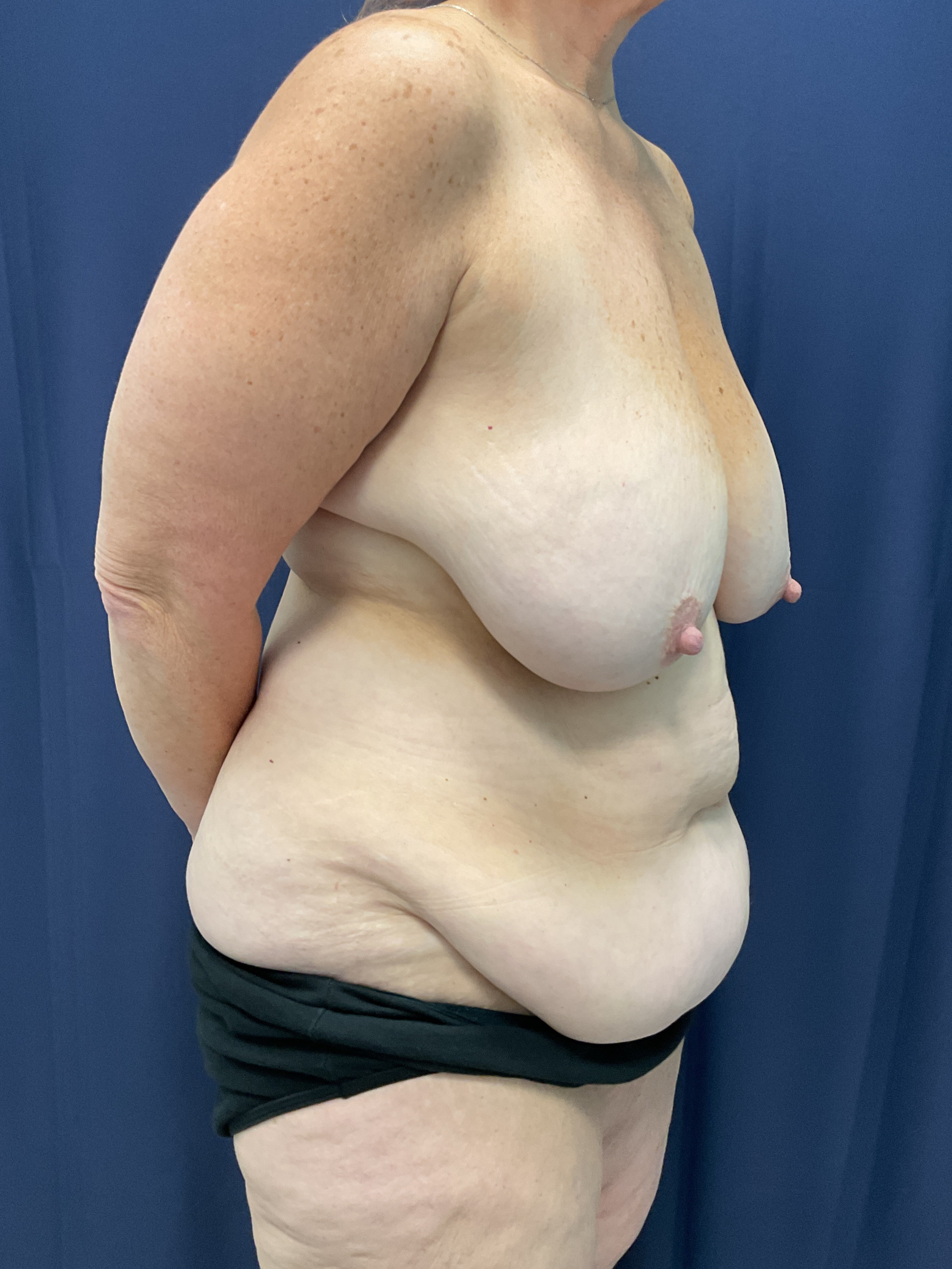 Abdominoplasty Patient Photo - Case 4558 - before view-2