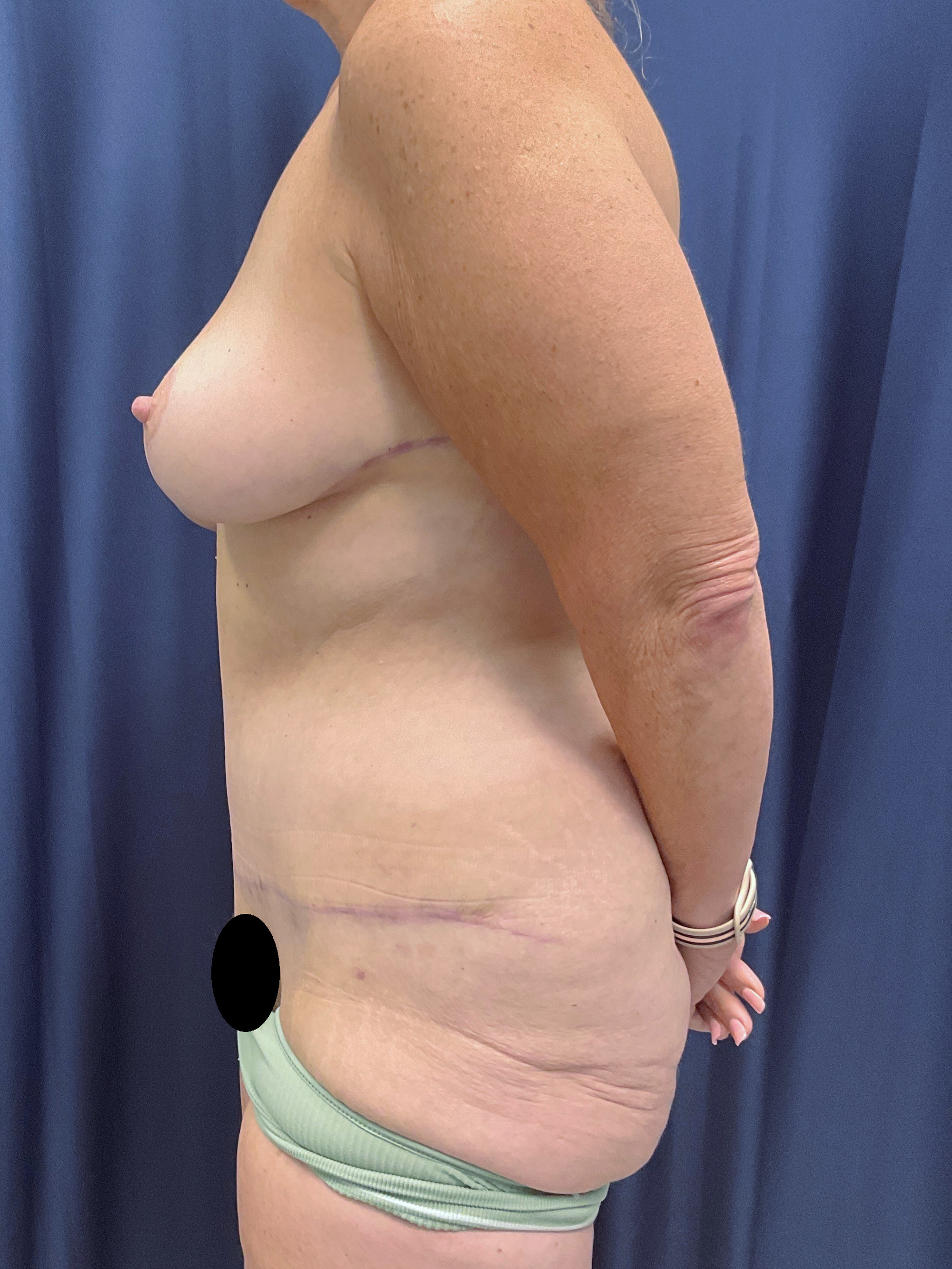 Abdominoplasty Patient Photo - Case 4558 - after view-5