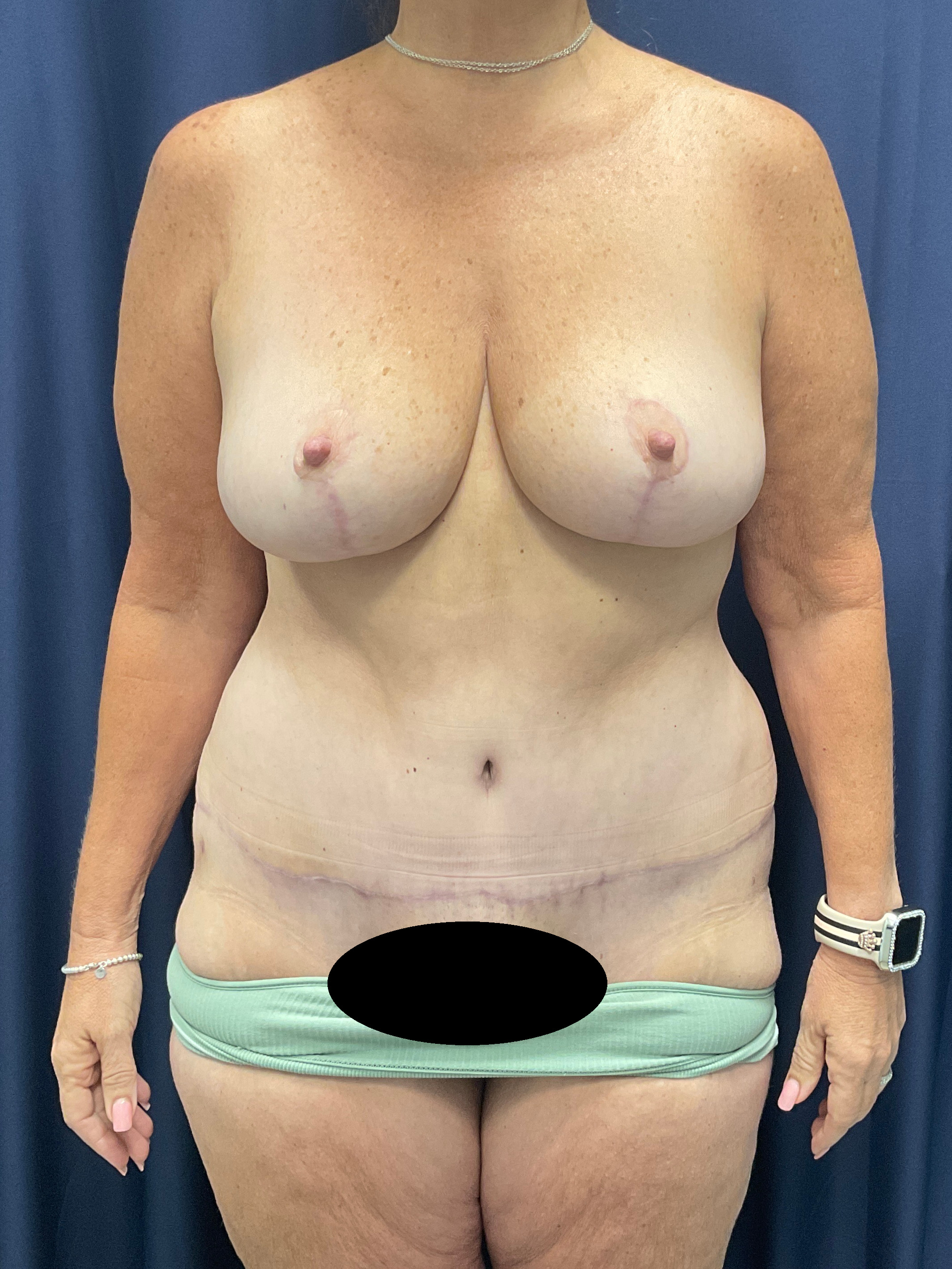 Abdominoplasty Patient Photo - Case 4558 - after view-1