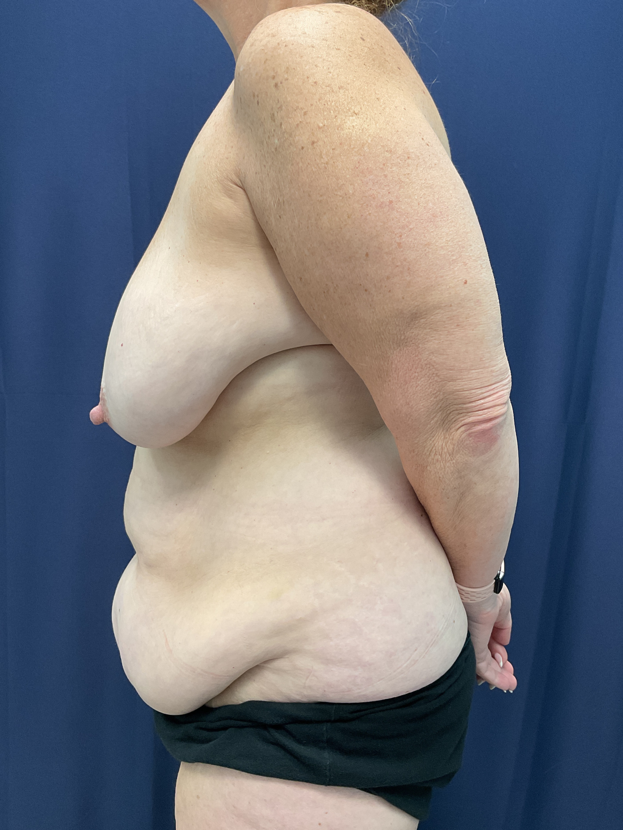 Abdominoplasty Patient Photo - Case 4558 - before view-5